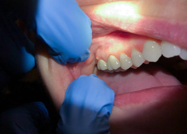 Best Tooth Infection Emergency Dentist  in Nice, CA
